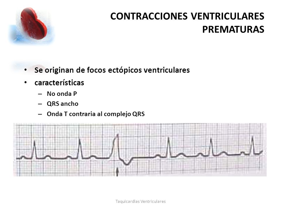 contracciones ventriculares prematuras